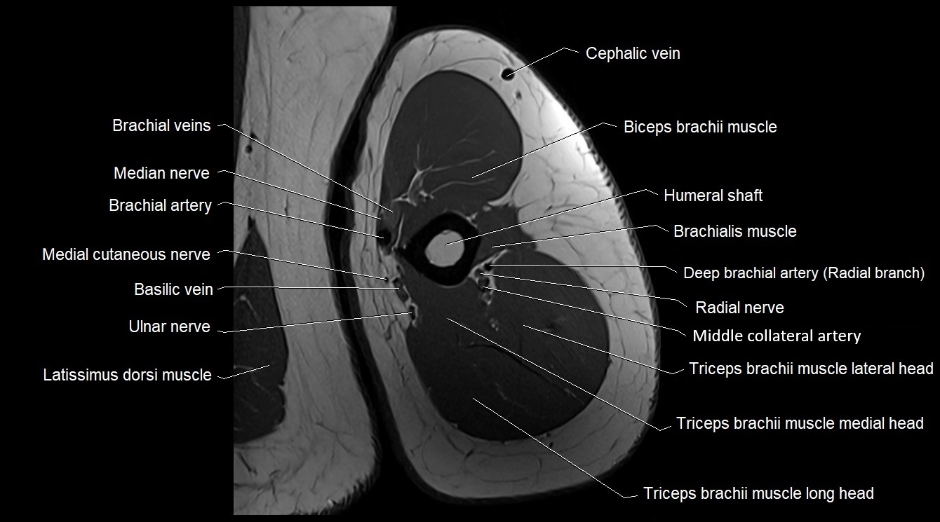 Upper arm( humerus) cross section anatomy MRI 3T axial image 33.webp